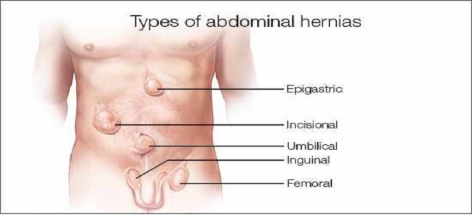 Abdominal Hernia